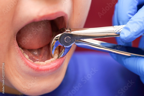 Child undergoing tooth extraction in a dental clinic