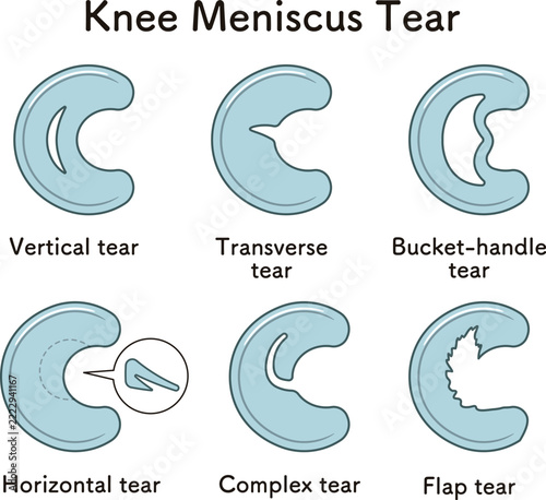 ひざ関節の半月板の断裂 Knee meniscus tear