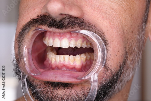 Close-Up of Teeth After Clear Aligner Treatment, Left Side