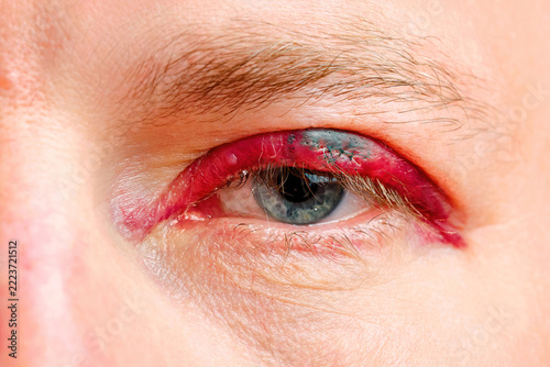 Fotografie Human eye with severely inflamed red upper eyelid after chalazion removal surgery, bruising and stitches