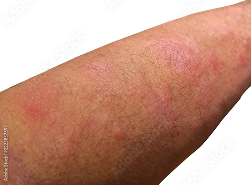 Red Skin Rash Irritation on Human Arm Isolated