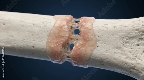 Bone fracture healing process showing callus formation and tissue regeneration