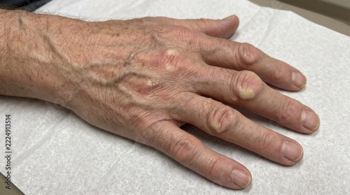 Chronic Tophaceous Gout Showing Chalky Nodules Around the Finger Joints
