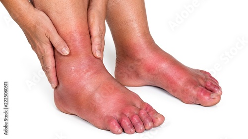 Closeup of swollen red feet and ankles with irritated skin, inflammation, tenderness and edema affecting both lower limbs isolated on white background
