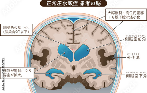 正常圧水頭症 Normal Pressure Hydrocephalus