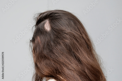 Woman with Patchy Hair Loss on Scalp, Alopecia Areata