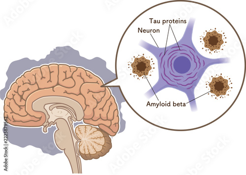 アルツハイマー病の脳　アミロイドβとタウたんぱく質The Alzheimer's Brain: Amyloid-beta & Tau Protein