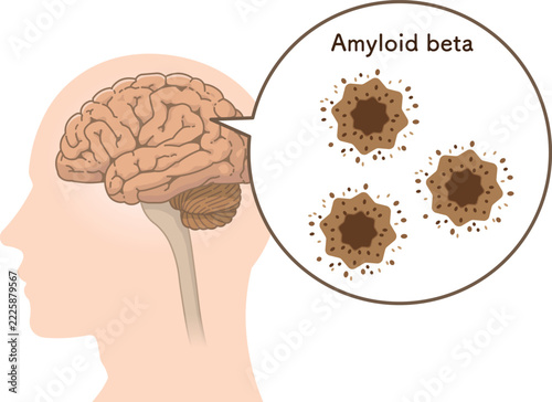 アルツハイマー病の脳　アミロイドβとタウたんぱく質The Alzheimer's Brain: Amyloid-beta & Tau Protein