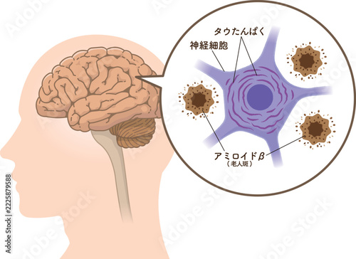 アルツハイマー病の脳　アミロイドβとタウたんぱく質The Alzheimer's Brain: Amyloid-beta & Tau Protein