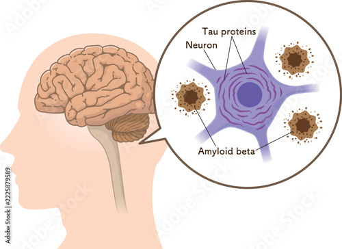 アルツハイマー病の脳　アミロイドβとタウたんぱく質The Alzheimer's Brain: Amyloid-beta & Tau Protein