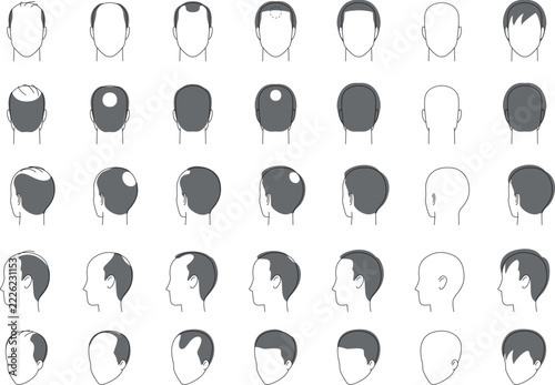 男性の薄毛の髪のタイプ。毛量の違いのベクターイラスト。