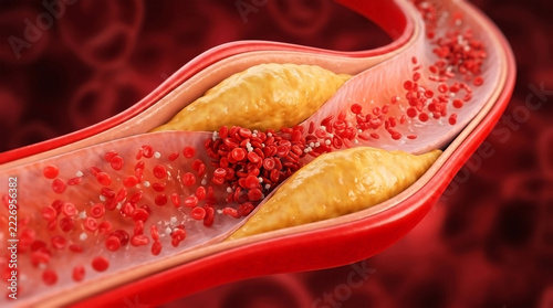Cholesterol Plaque in Human Artery with Red Blood Cells 3D Medical Illustration of Atherosclerosis Blockage for Healthcare Science Web Banner.