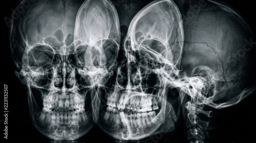 A surreal digital art montage of overlapping human skull x rays visually representing the dangers of expired medication through multiple translucent skeletal overlays